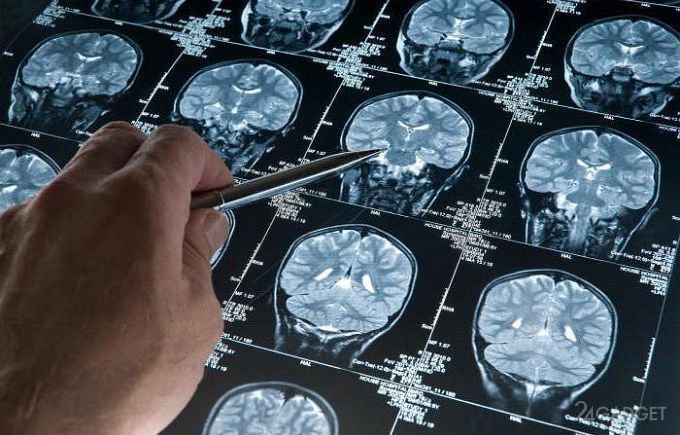 Заблаговременно предупредить об Альцгеймере поможет нейросеть