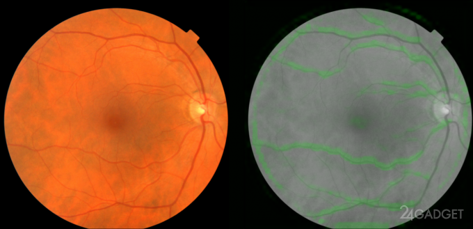 Алгоритм Google определит сердечные недуги по глазам (3 фото)