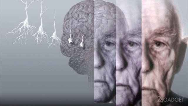 Россияне приблизились к излечению болезней Альцгеймера и Паркинсона
