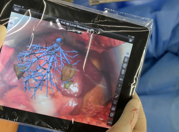 На iPad вышло приложение для печеночной хирургии