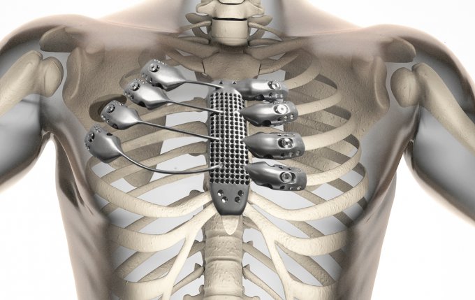 В Испании пациенту вживили напечатанные на 3D-принтере грудину и ребра (3 фото + видео)