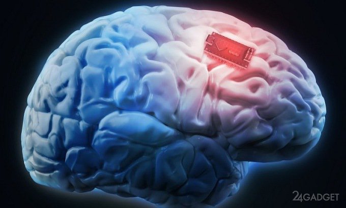 Человеку впервые улучшили память мозговым имплантом
