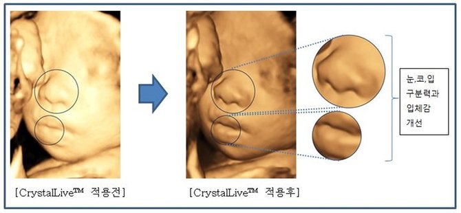 Samsung CrystalLive повысила точность ульразвуковой диагностики (2 фото)