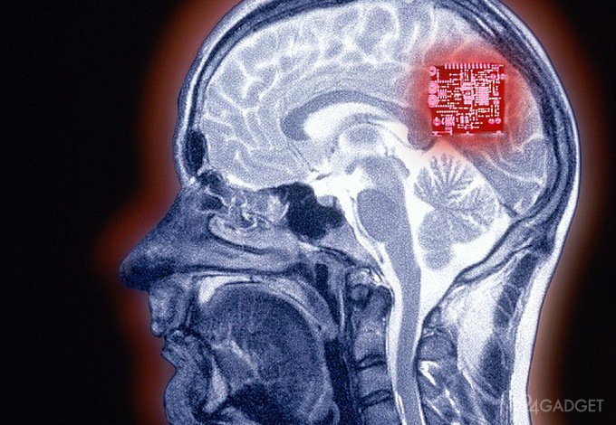 Мозговой имплантат переведёт мысли в речь (3 фото)
